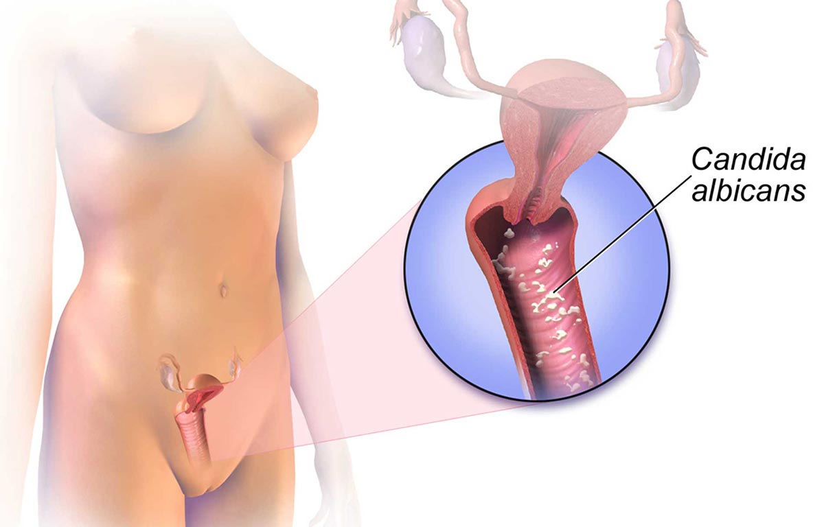 Vaginalna gljivična infekcija