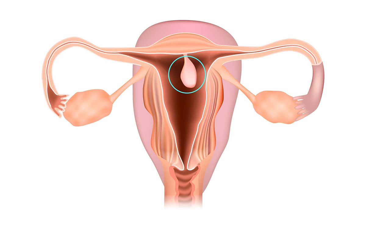 Endometrijalni polipi